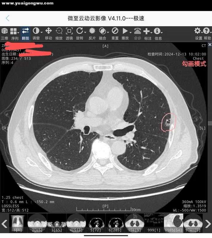 肺部高危结节1-5.jpg